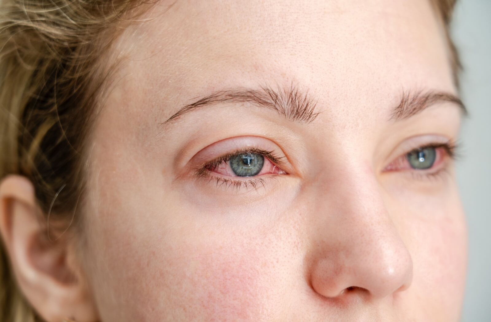 Close-up of a person with irritated red eyes possibly caused by meibomian gland dysfunction