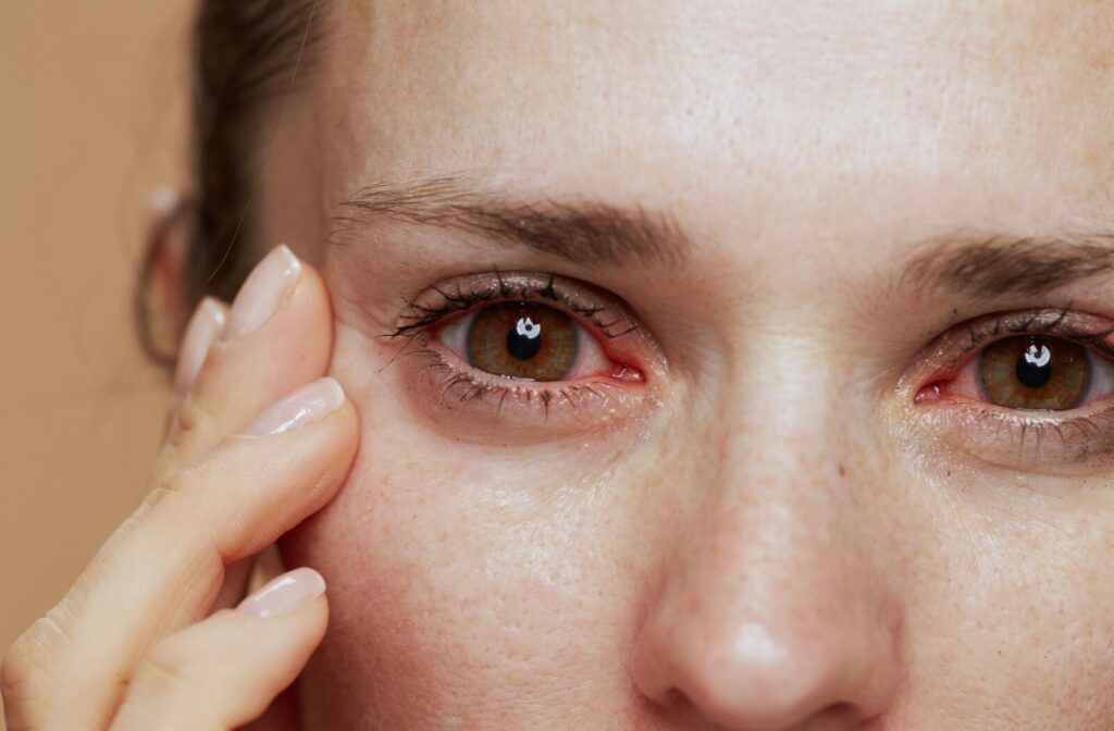 A close-up of a person's red, watery, and irritated eyes.