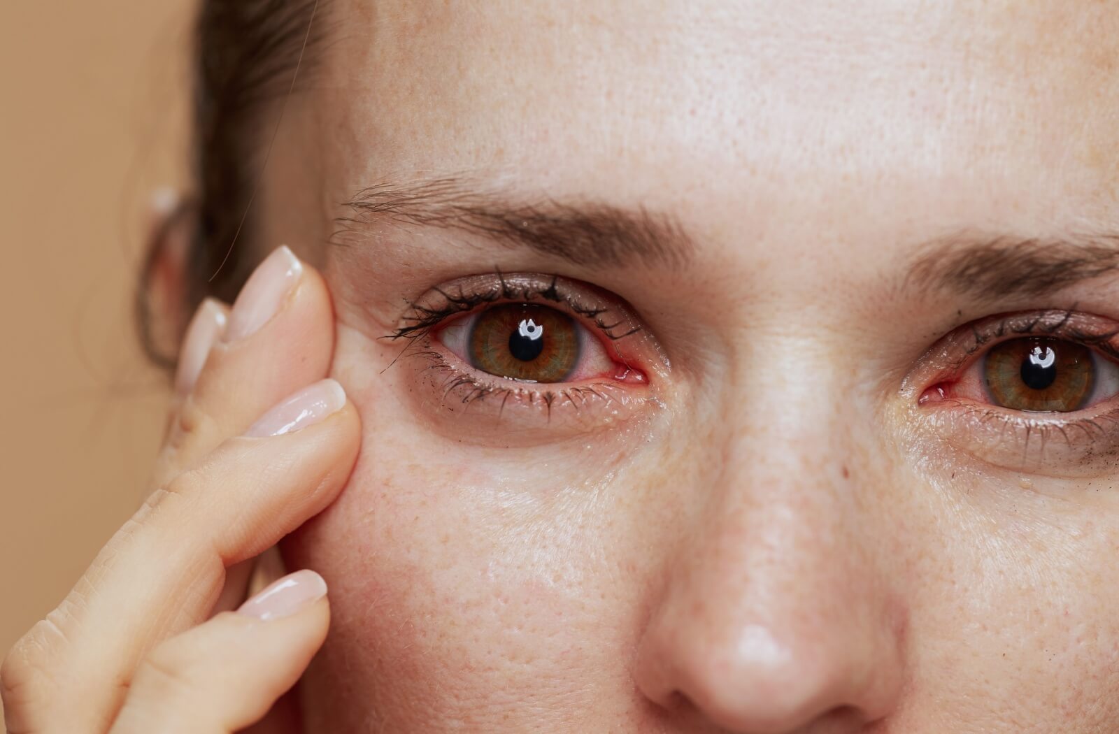 A close-up of a person's red, watery, and irritated eyes.