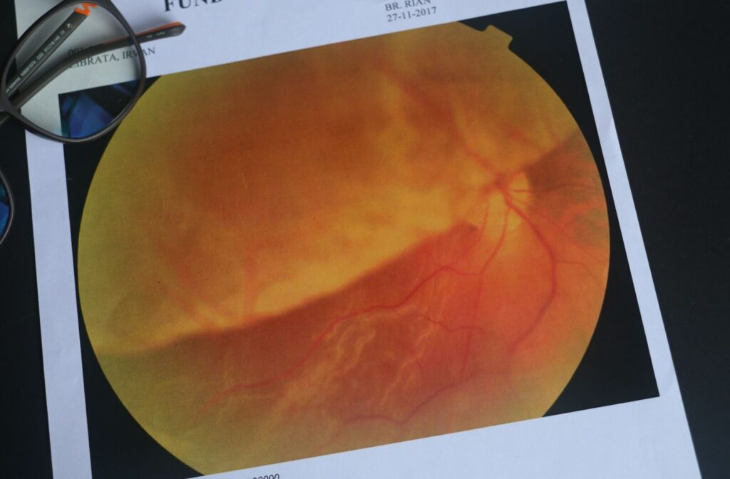 Close-up of a printed digital retinal image showing the orange and yellow patterns of the eye’s internal structures, with a pair of glasses resting on the paper.