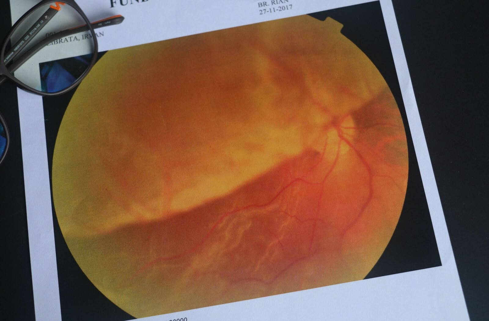Close-up of a printed digital retinal image showing the orange and yellow patterns of the eye’s internal structures, with a pair of glasses resting on the paper.