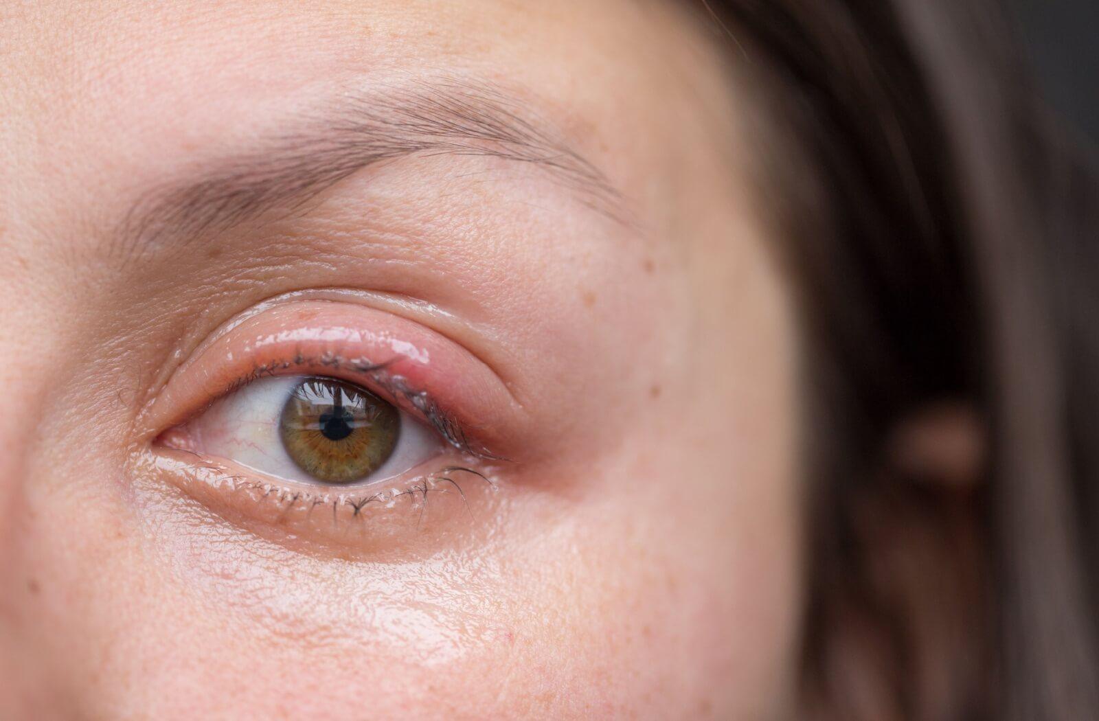 A close-up of a person's eye showing a red, swollen, and crusty upper eyelid, indicating symptoms of blepharitis.