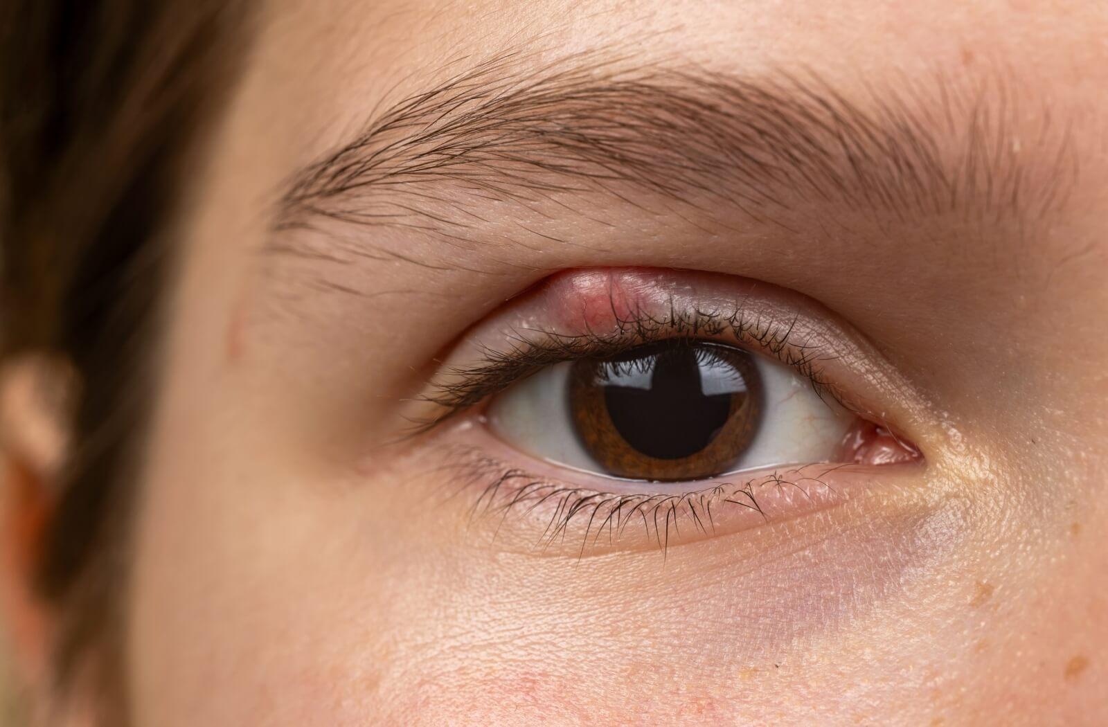 A close-up view of a person's eye with a localized red bump on the upper lash line, representing a stye or inflamed eyelid gland.